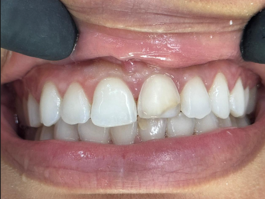 Sorriso Antes do Procedimento