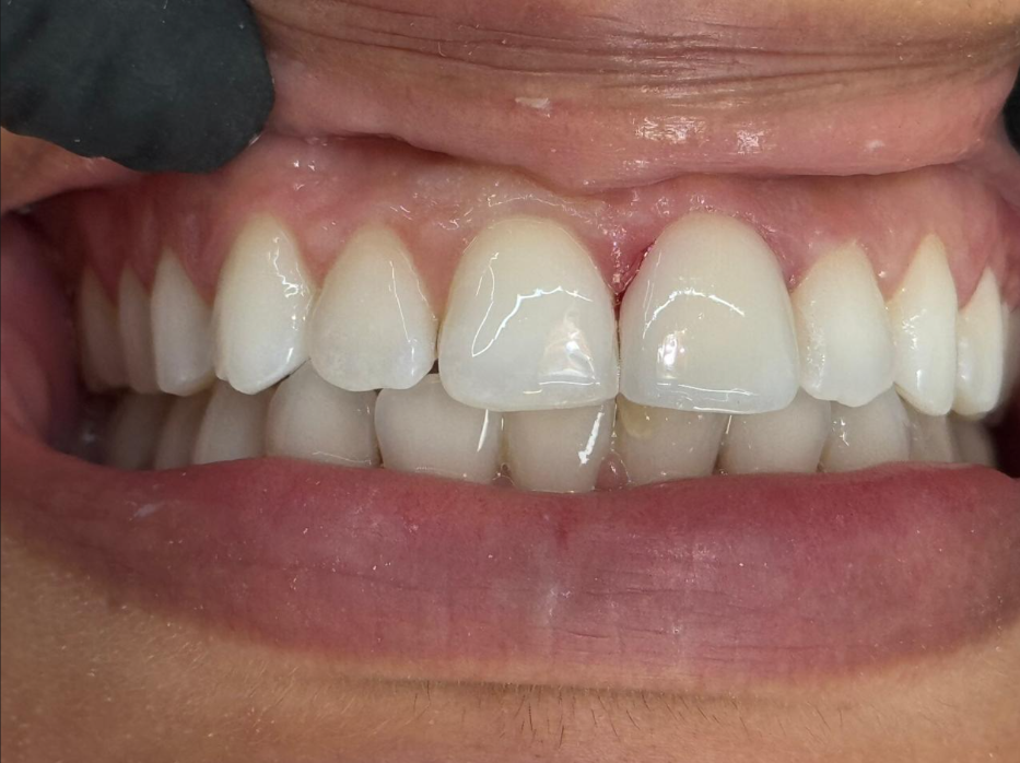 Sorriso Depois do Procedimento
